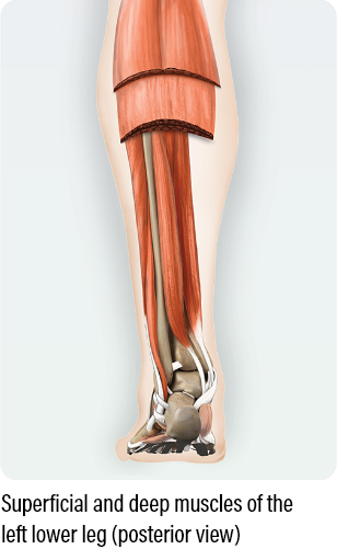 Dosing and administration for adult LLS medical diagram with a posterior view showing how to dose and administer dysport for superficial muscles of the left lower leg in adults with lower limb spasticity